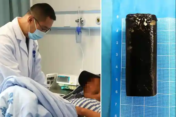 lighter removed from stomach china hospital