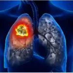 lung cancer