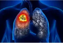 lung cancer