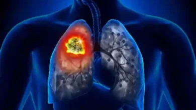 lung cancer
