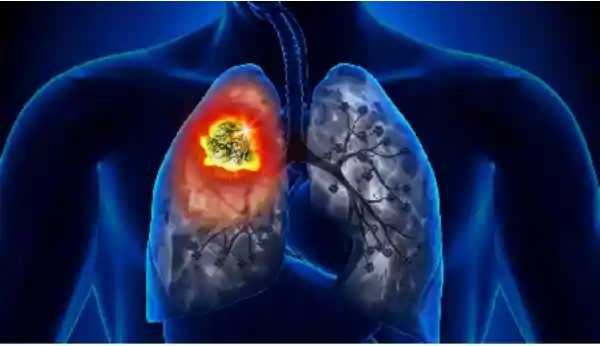 lung cancer